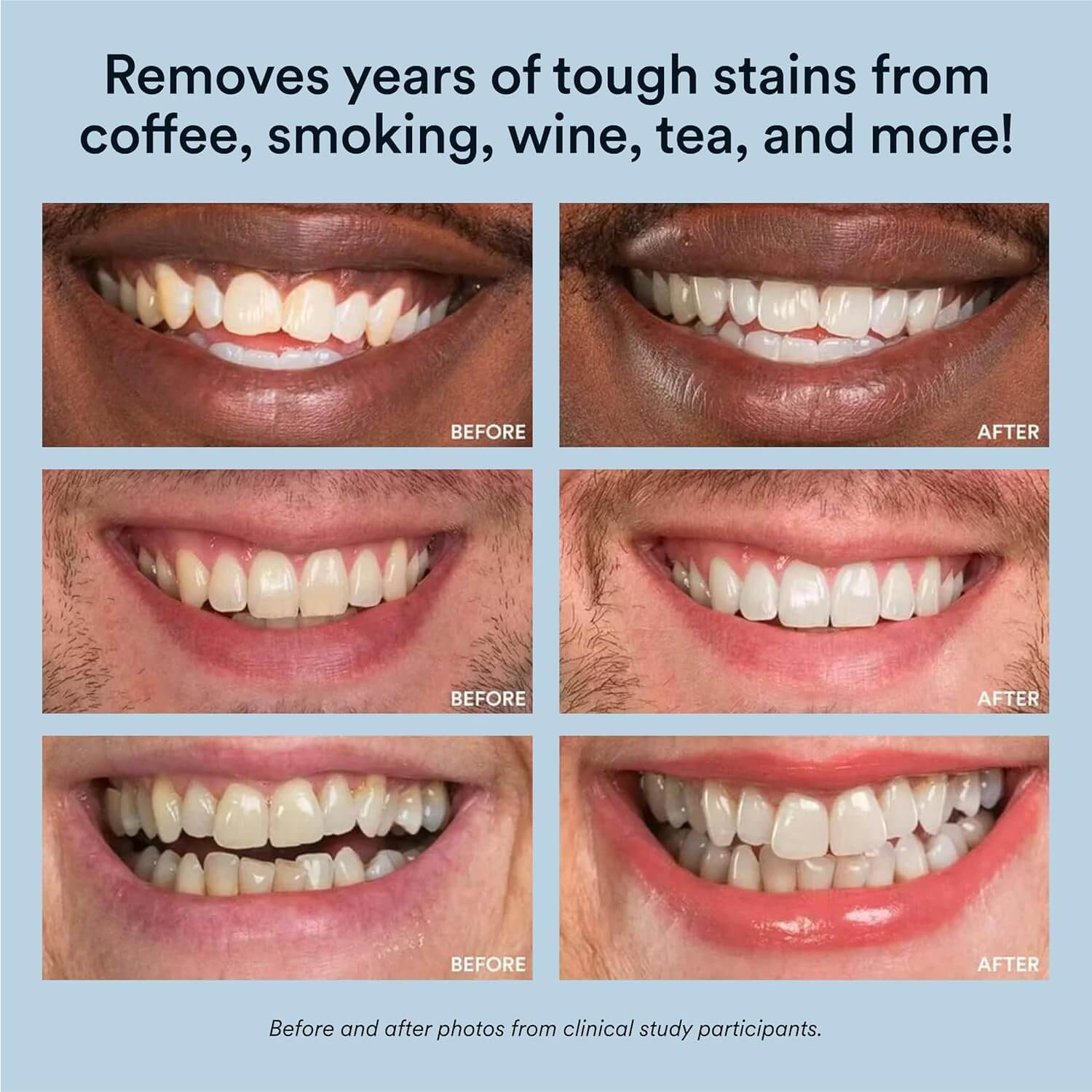 Auraglow Teeth Whitening Kit | Whitening Kit With LED Light