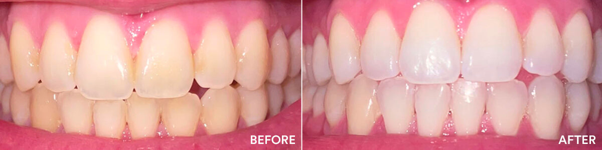 Before and after teeth whitening result