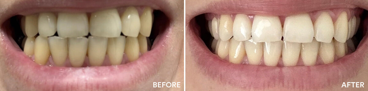 Before and after teeth whitening result