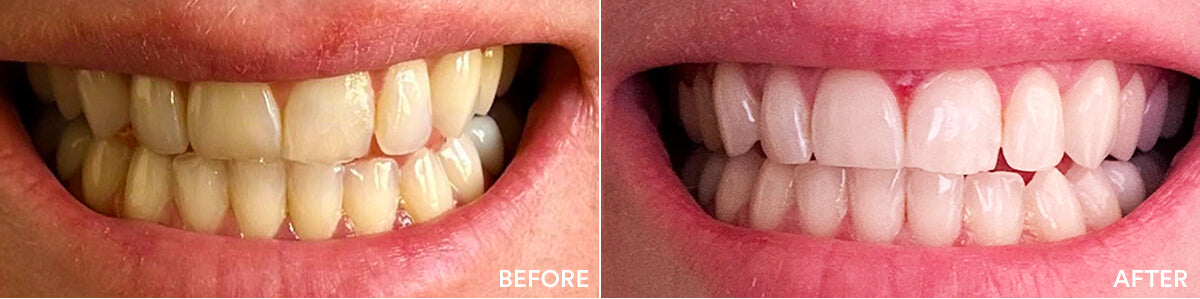 Before and after teeth whitening result