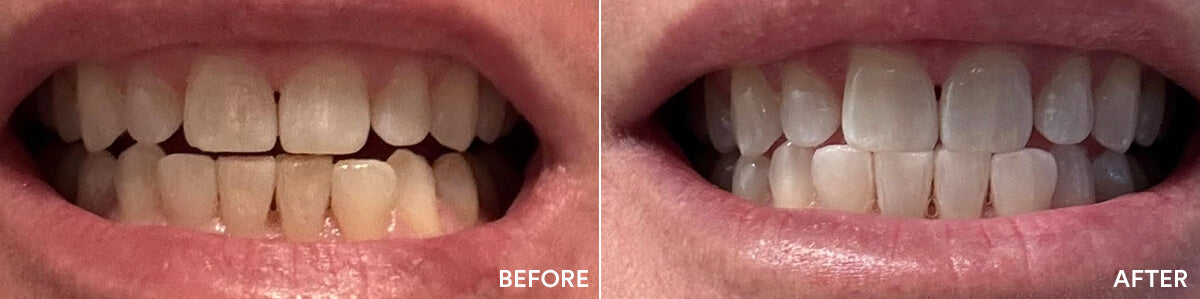 Second Auraglow before and after teeth whitening result