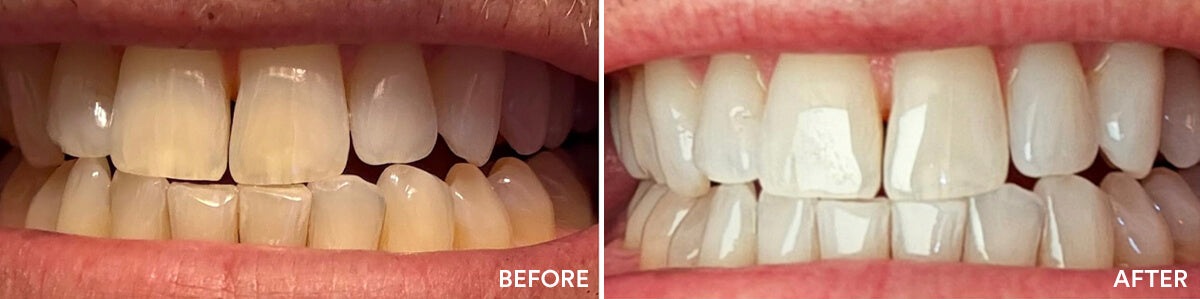Third Auraglow before and after teeth whitening result